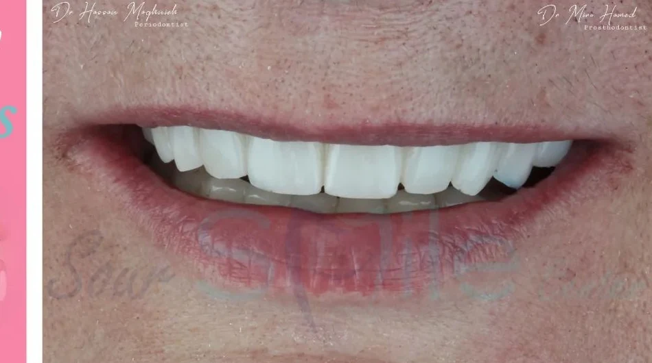 After dental treatment