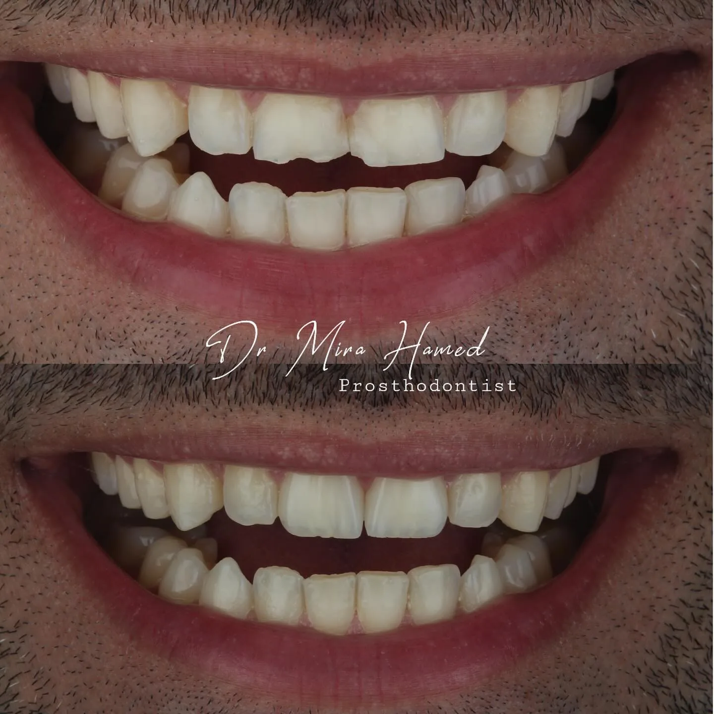 Before and after: two veneers
