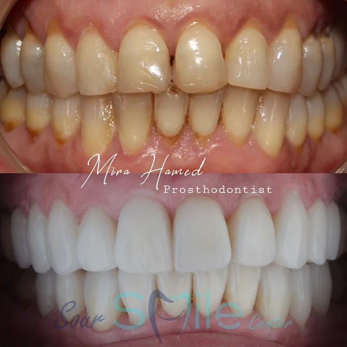 Before and after: veneers
